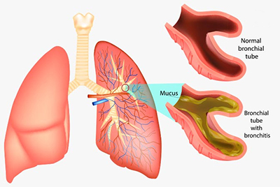 Chronic Bronchitis