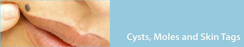 Cysts, Moles and Skin Tags