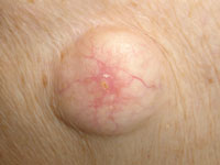 cyst