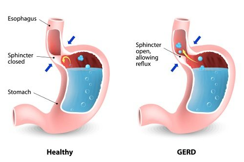 Adrenal Fatigue