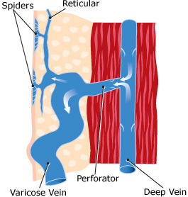 spider veins