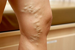 spider veins