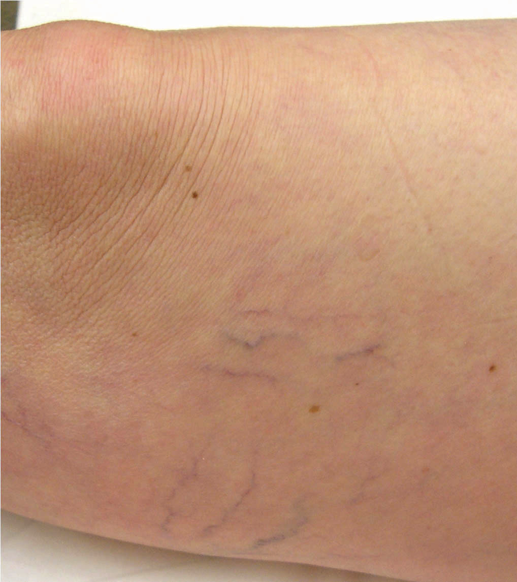 Vein before