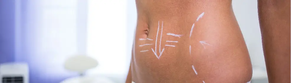 Liposuction