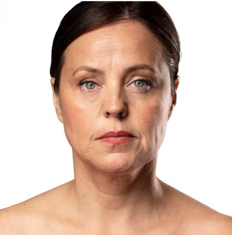 Root-Causes-of-Facial-Wrinkles