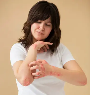What Are Burns?