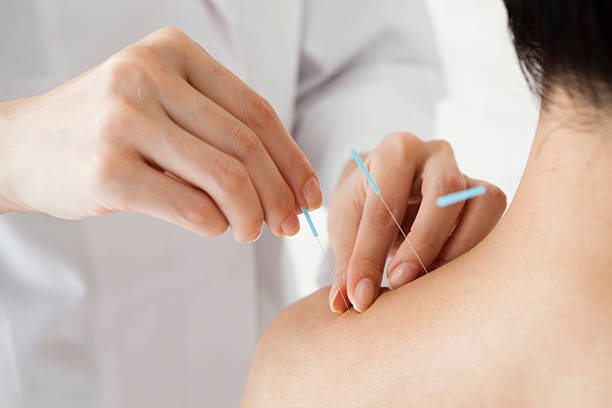 acupuncture-1