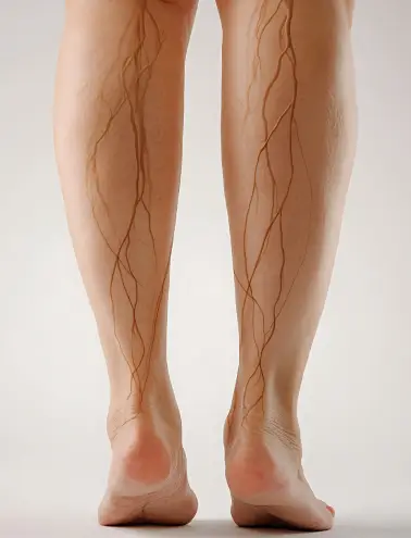 Emma’s Vein Recovery