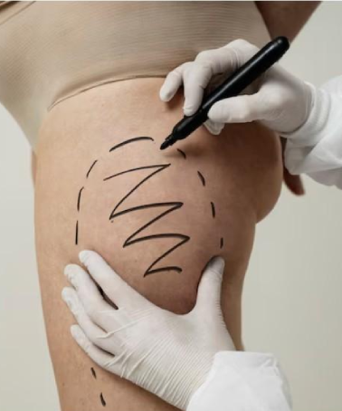 At Patients Medical, we investigate the underlying causes of vascular dysfunction. These may include: Chronic Inflammation: Inflammatory cytokines can damage blood vessel walls and valves over time. Poor Circulation & Sedentary Lifestyle: Lack of movement impairs venous return, especially from the legs. Oxidative Stress & Toxin Exposure: Toxins like heavy metals damage endothelial lining and impair blood flow. Hormonal Imbalances: Estrogen dominance or thyroid dysfunction can weaken vessel tone. Insulin Resistance or Diabetes: High blood sugar damages capillaries and impairs oxygen delivery. Mitochondrial Dysfunction: Weak cellular energy production compromises muscle pumping action that supports venous return.