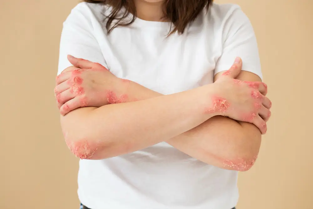 Psoriasis & Autoimmune Skin Disease
